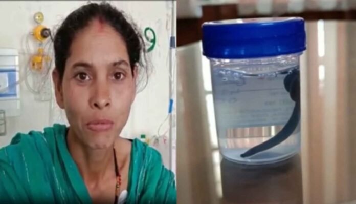 Doctors pulled out a 5 cm long leech stuck in a woman's trachea in Pauri Garhwal, watch video Doctors pulled out a 5 cm long leech stuck in a woman's trachea in Pauri Garhwal, watch video